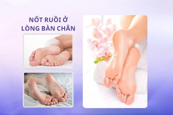 Nốt ruồi nằm ở lòng bàn chân – Chủ tài vận, số giàu sang