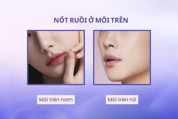 Nốt ruồi ở môi trên – Nốt ruồi lộc ăn