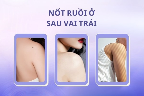 Nốt ruồi ở sau vai trái – Nốt ruồi gánh nặng