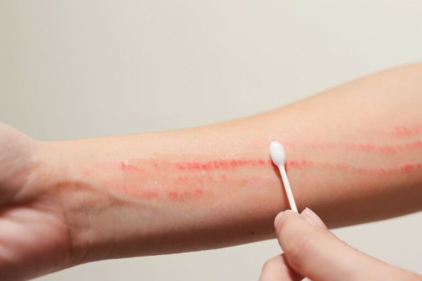 Thoa thuốc mỡ đều đặn để làm dịu vết thương và thúc đẩy quá trình phục hồi hiệu quả hơn