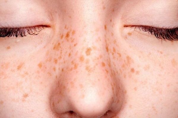 Tàn nhang là bệnh lý da liễu thường gặp , gây ảnh hưởng không nhỏ đến vấn đề thẩm mỹ