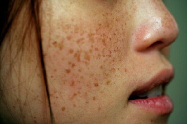 Cách xóa tàn nhang hiệu quả