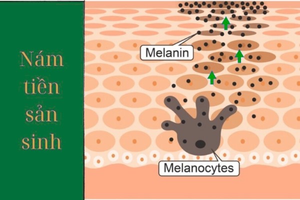Giai đoạn sản xuất melanin