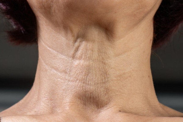 Tình trạng da cổ bị sần sùi, kèm theo các vết thâm gây ảnh hưởng lớn đến tính thẩm mỹ