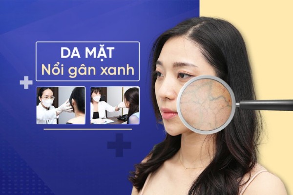 Nguyên nhân da mặt nổi gân xanh và cách điều trị