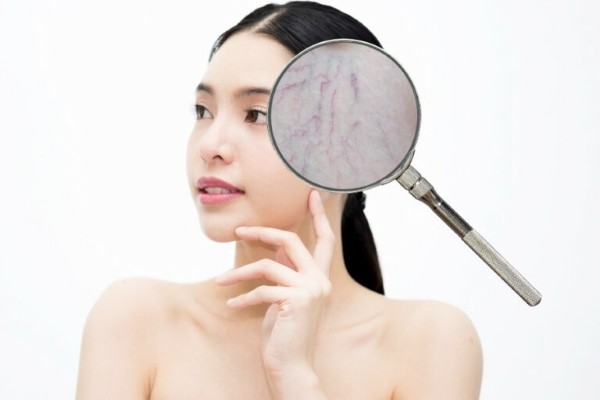 Tình trạng suy giãn tĩnh mạch ở thái dương có thể là biểu hiện của một số bệnh lý nguy hiểm