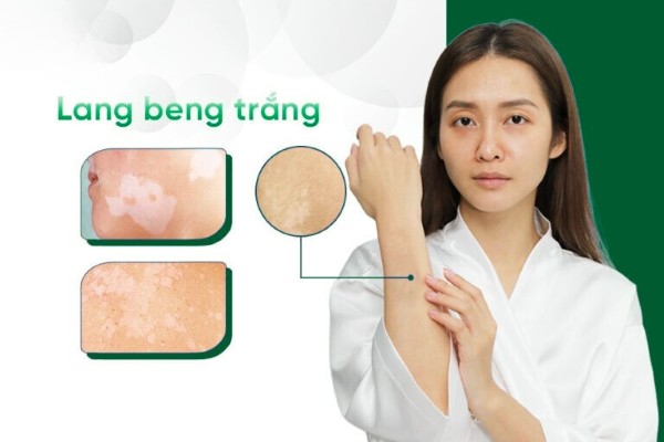 Nguyên nhân và cách điều trị, cải thiện lang ben trắng hiệu quả