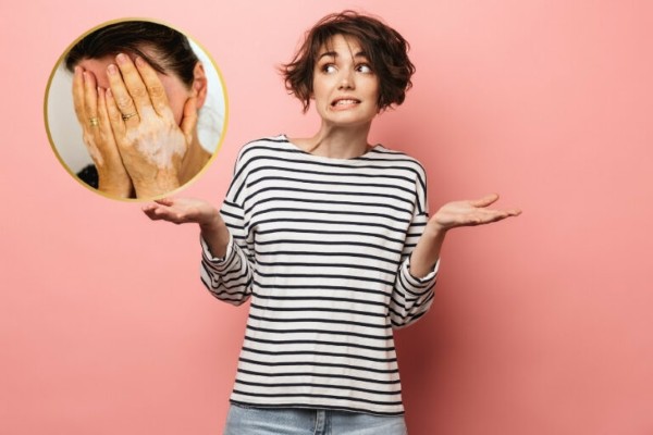 Bệnh lang ben trắng có lây không?