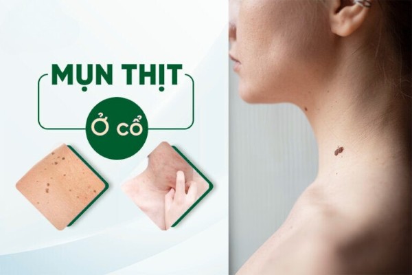 Mụn thịt ở cổ là bệnh gì?