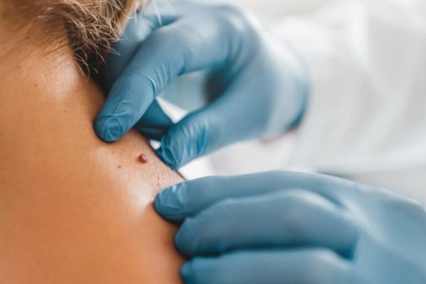 Cách trị mụn thịt ở cổ bằng phương pháp thẩm mỹ