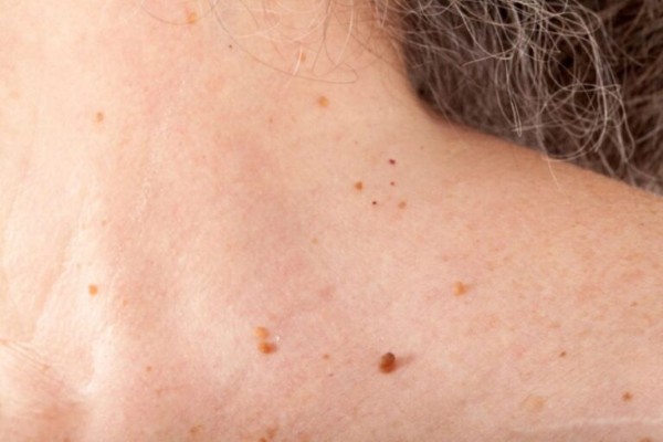 Nổi mụn thịt ở cổ là bệnh gì?