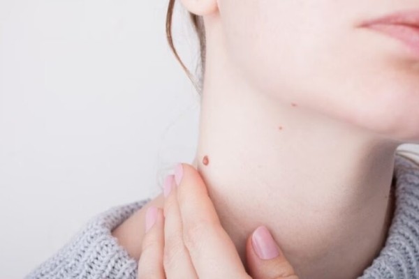 Tại sao bị nổi mụn thịt ở cổ?