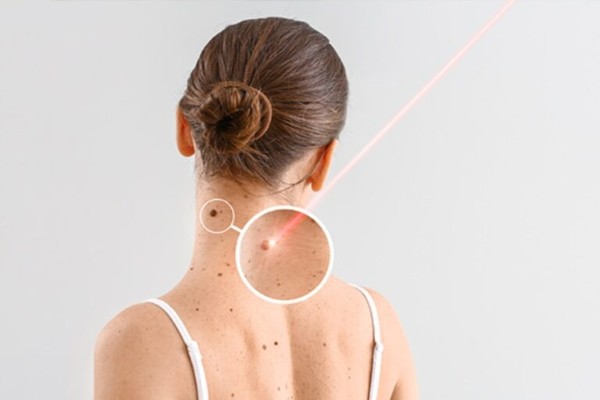 Cách nhận biết mụn thịt ở cổ