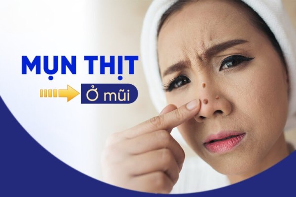 Nguyên nhân bị mụn thịt ở mũi và cách điều trị hiệu quả