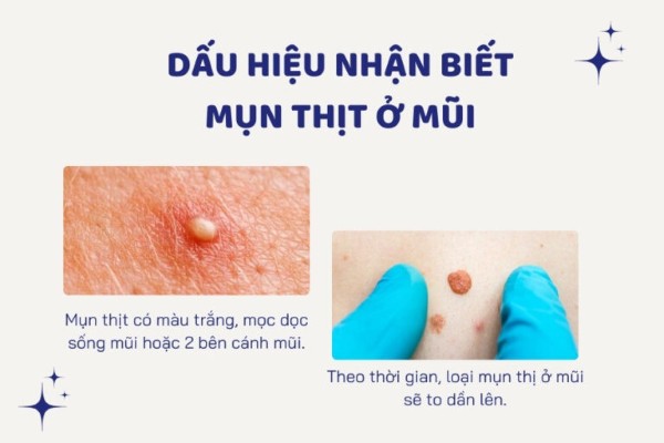 Mụn thịt ở mũi là những mốt mụn màu trắng, nổi cộm trên da và to dần theo thời gian