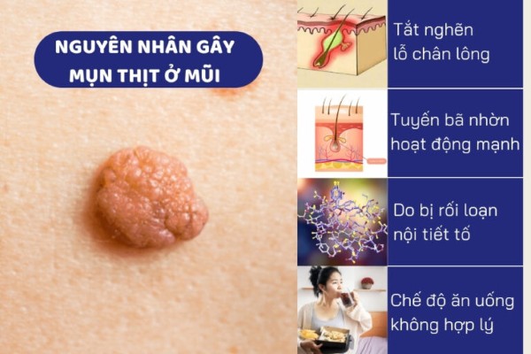 Rối loạn chuyển hóa dưới da là nguyên nhân chính gây ra mụn thịt