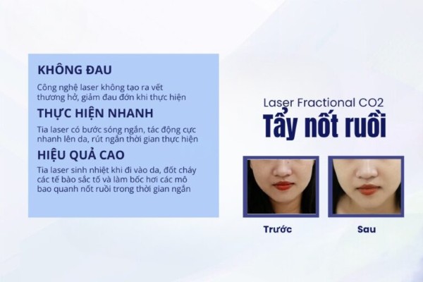Nốt ruồi ở ngón tay út – Dấu hiệu của trí tuệ và phúc khí?