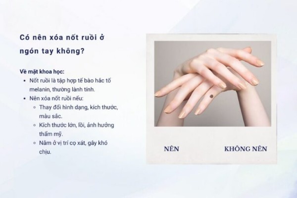 Có nên xóa nốt ruồi ở ngón tay không?