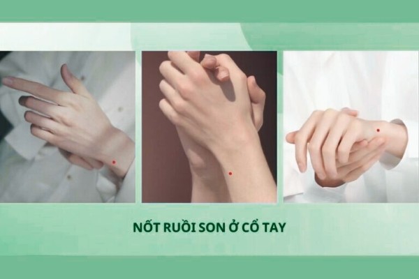 Nốt ruồi đỏ ở cổ tay – Tính cách tốt, nhiều người yêu quý Nốt ruồi đỏ ở cổ tay – Tính cách tốt, nhiều người yêu quý