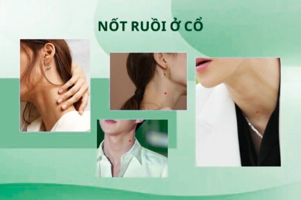 Mụn ruồi son ở cổ – Nốt ruồi tài lộc, giàu sang Mụn ruồi son ở cổ – Nốt ruồi tài lộc, giàu sang
