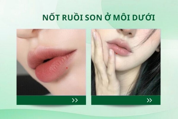 Mụn ruồi son ở môi dưới – Dấu hiệu của cuộc sống đủ đầy và viên mãn Mụn ruồi son ở môi dưới – Dấu hiệu của cuộc sống đủ đầy và viên mãn