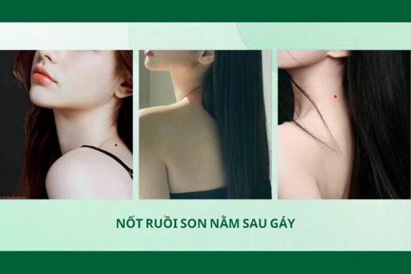 Nốt ruồi son sau gáy – Biểu tượng của tài năng và sự hòa nhã Nốt ruồi son sau gáy – Biểu tượng của tài năng và sự hòa nhã