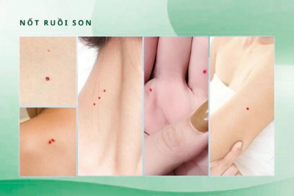 Thế nào là nốt ruồi son? Thế nào là nốt ruồi son?