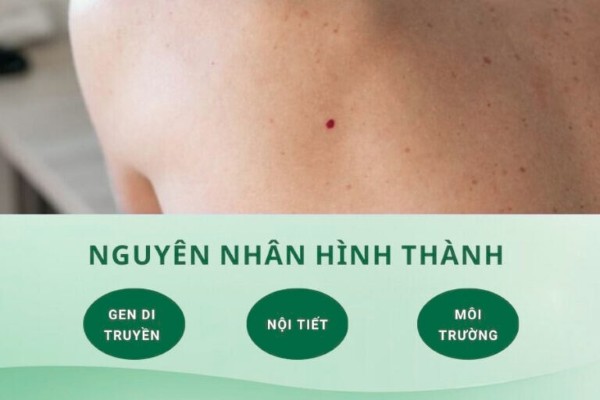 Nguyên nhân hình thành các mụn ruồi son là gì? Nguyên nhân hình thành các mụn ruồi son là gì?