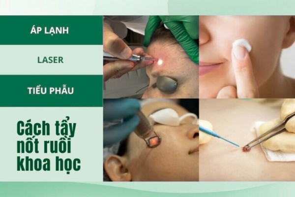 Làm sao xóa nốt ruồi son an toàn? Làm sao xóa nốt ruồi son an toàn?