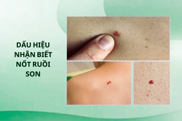 Dấu hiệu nhận biết nốt ruồi son trên da Dấu hiệu nhận biết nốt ruồi son trên da