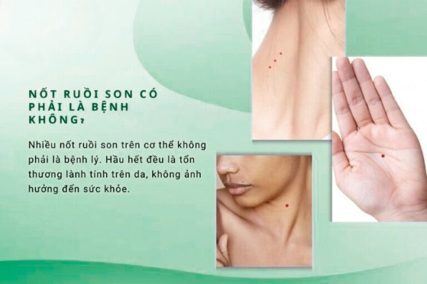 Nốt ruồi son có phải là bệnh không? Nốt ruồi son có phải là bệnh không?