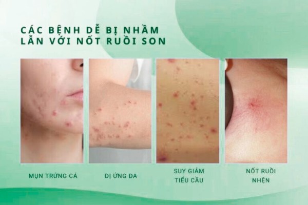 Các bệnh dễ bị nhầm lẫn với nốt ruồi son Các bệnh dễ bị nhầm lẫn với nốt ruồi son
