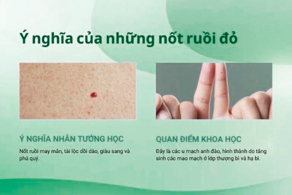 Ý nghĩa của những nốt ruồi son là gì? Ý nghĩa của những nốt ruồi son là gì?