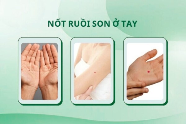 Nốt ruồi son ở tay – Biểu tượng của sự thịnh vượng và giàu có Nốt ruồi son ở tay – Biểu tượng của sự thịnh vượng và giàu có