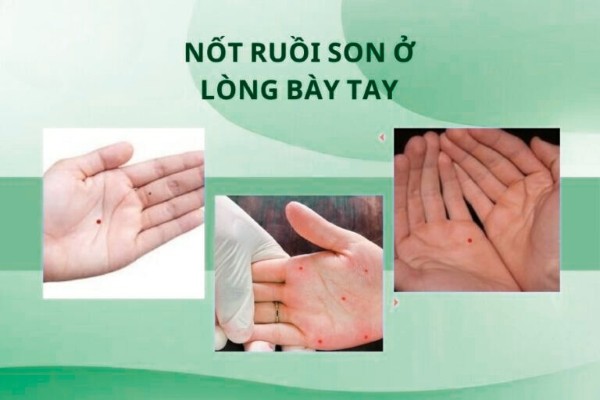 Xem tướng mụn ruồi son ở lòng bàn tay Xem tướng mụn ruồi son ở lòng bàn tay
