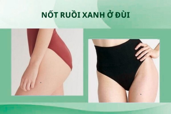 Nốt ruồi xanh ở đùi – Hậu vận an nhàn, vô lo