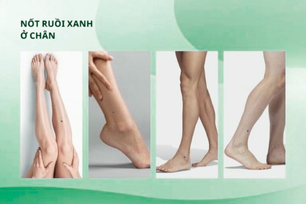 Nốt ruồi xanh ở chân – Dấu hiệu của tiền tài, vật chất