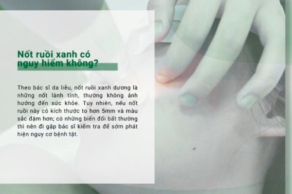 Nốt ruồi xanh có nguy hiểm không?