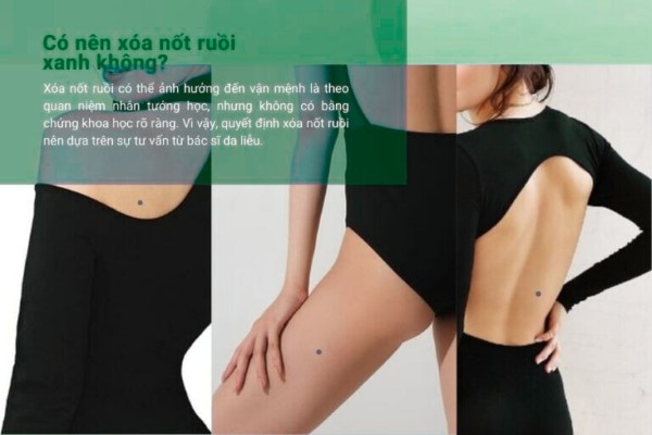 Nên làm gì khi có nốt ruồi xanh trên cơ thể? Có nên xóa không?