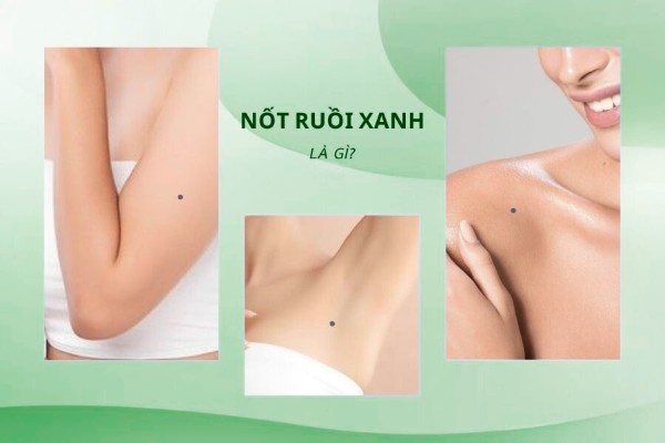 Nốt ruồi màu xanh có ý nghĩa gì trong nhân tướng học?