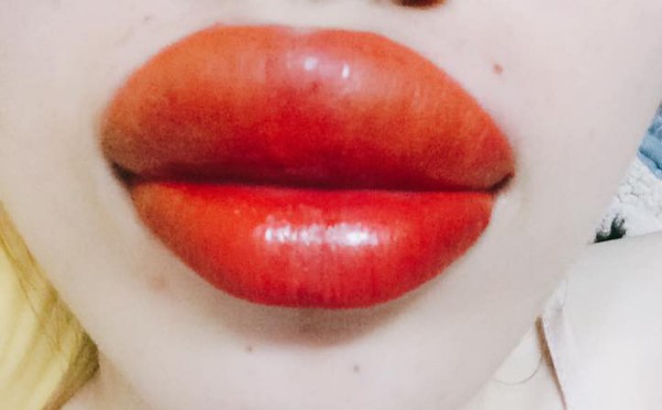 Môi bị sưng sau phun