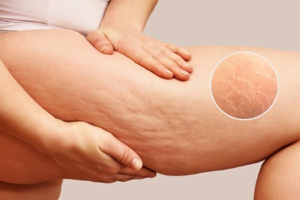 Béo phì và tăng cân đột ngột làm rạn da đùi Béo phì và tăng cân đột ngột làm rạn da đùi