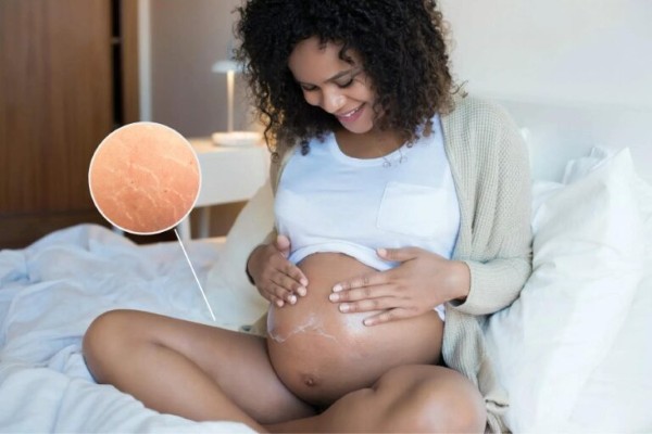 Mang thai là một trong những nguyên nhân gây rạn da đùi Mang thai là một trong những nguyên nhân gây rạn da đùi