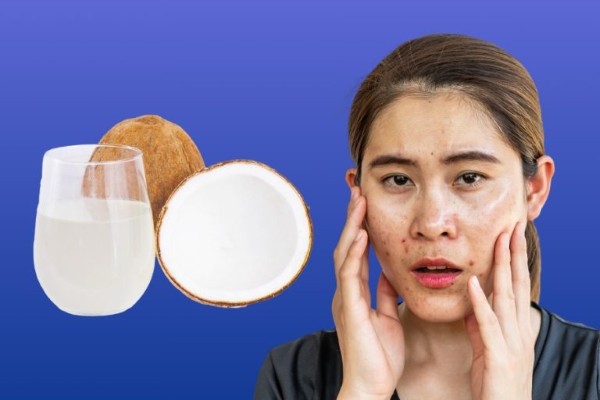 Nước dừa chứa các thành phần giúp giảm viêm và làm dịu da. Nước dừa chứa các thành phần giúp giảm viêm và làm dịu da.