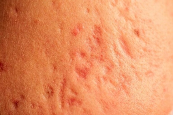 Quá trình tăng sản xuất elastin quá mức sẽ hình thành những vết sẹo đỏ “xấu xí”