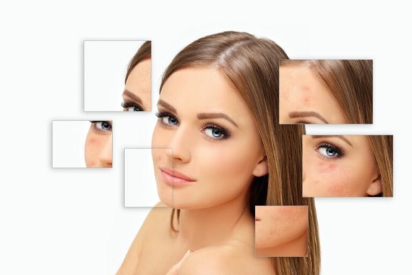 Sẹo thâm đỏ có tự hết không? Theo đó, sẹo đỏ sẽ không thể tự biến mất nếu không được điều trị đúng cách