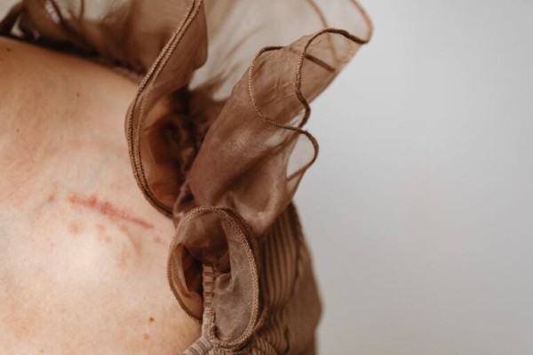 Sẹo đỏ có thể được hình thành do tình trạng tăng hoặc giảm sắc tố