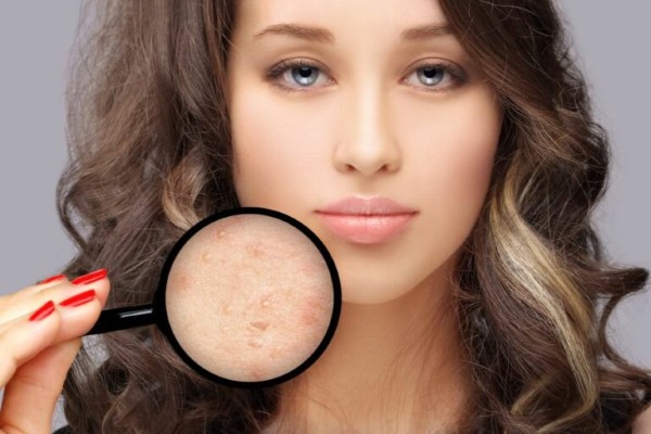 Việc tự ý nặn mụn có thể hình thành sẹo đỏ