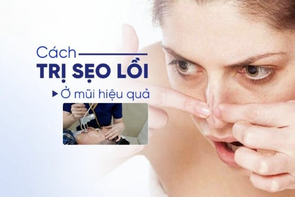 Sẹo lồi ở mũi là gì? Nguyên nhân & 6 cách trị hiệu quả, an toàn