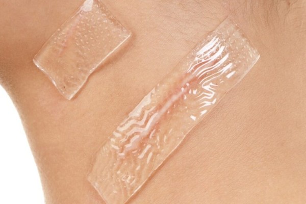 Dán silicone điều trị sẹo trắng